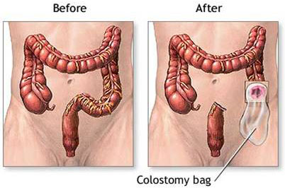 Colostomy & Colostomy Bags
